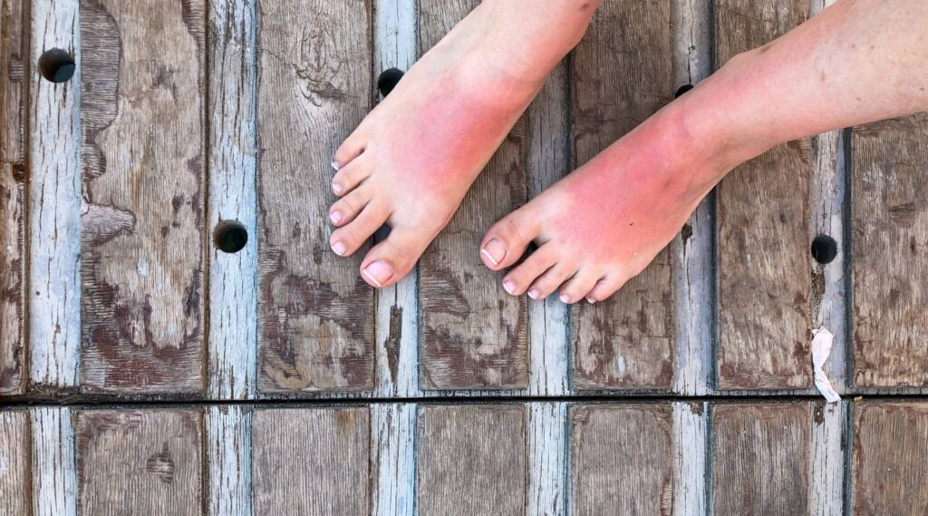 Common Sun Poisoning Symptoms to Watch For