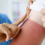 sun poisoning symptoms