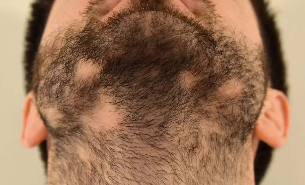 Why Is My Beard Patchy? The Root Causes Explained